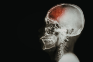 Traumatisme cranien